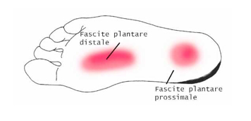 Centro Fisioterapico Aurelio fascite plantare