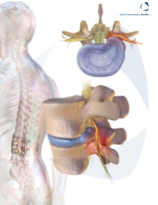 Radicolopatia disco intervertebrale - Centro Fisioterapico Aurelio