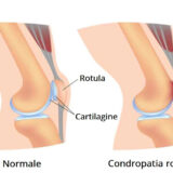 Condropatia rotulea - Centro Fisioterapico Aurelio
