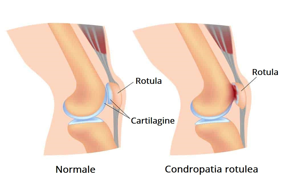 condropatia-rotula.jpeg